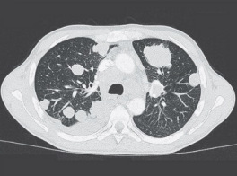 Guzki w pucach, TK; http://www.nejm.org/doi/ref/10.1056/NEJMoa1505892#t=article