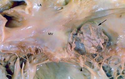 Wntrze serca zmarej pacjentki – strzaka wskazuje na wegetacj na tylnym patku zastawki mitralnej (MV, mitral valve), LA – lewy przedsionek; CC-BY, https://www.ncbi.nlm.nih.gov/pmc/articles/PMC5087979/