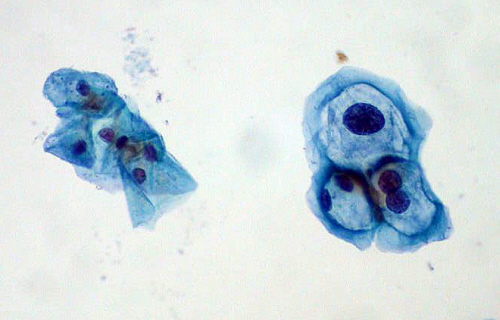 Cytologia ginekologiczna; po prawej komórki nabonka paskiego z cechami infekcji HPV (ostro odgraniczone przejanienie wokó jdra komórkowego); Ed Uthman, domena publiczna
