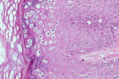 Efekty skórnej infekcji HPV – skórna brodawka wirusowa; http://www.fujita-hu.ac.jp/~tsutsumi/case/case180.htm