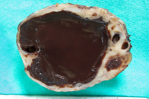 Torbiel czekoladowa (endometrialna) jajnika; bc the path, flickr; CC BY-NC 2.0