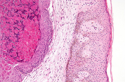 Mięczak zakaźny, po lewej intensywnie różowe ciałka mięczakowate; Nephron, Wikipedia; CC BY-SA 3.0