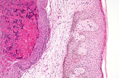 Miczak zakany, po lewej intensywnie róowe ciaka miczakowate; Nephron, Wikipedia; CC BY-SA 3.0