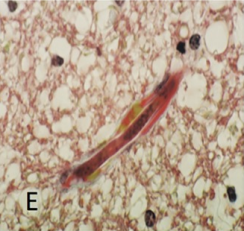 Martwa po leczeniu mikrofilaria w drobnym naczynku mózgowym; CC-BY, https://www.ncbi.nlm.nih.gov/pmc/articles/PMC5533442/