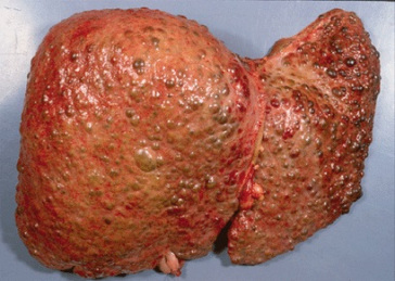 Guzkowo przebudowana marska wtroba, CC BY 4.0, https://www.omicsonline.org/india/cirrhosis-peer-reviewed-pdf-ppt-articles/