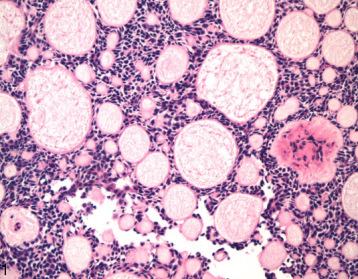 ACC linianki; ©2010 College of American Pathologists z pozwoleniem na udostpnianie dla celów naukowych i edukacyjnych; http://www.archivesofpathology.org/doi/pdf/10.1043/2009-0527-RS.1