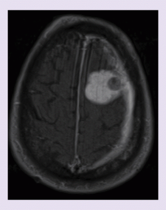 <span>Obraz MRI sześćdziesięcioczteroletniego mężczyzny z oponiakiem (większy biały obszar), w obrębie którego wykryto przerzut raka gruczołowego najprawdopodobniej płuca; </span>https://www.ncbi.nlm.nih.gov/pmc/articles/PMC5977278/