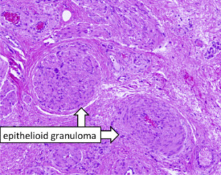 <span>Ziarniniaki skóry moszny w przebiegu terapii BCG; CC BY-NC-ND 4.0, </span>https://www.sciencedirect.com/science/article/pii/S2214442016301589