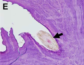 W centrum mas tworzcych zóg znaleziono drobny wos; CC BY 4.0, https://bmcophthalmol.biomedcentral.com/articles/10.1186/s12886-018-0915-y