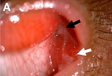 W kciku zmienionego oka pojawi si guzek zapalny (czarna strzaka) i drobna przetoka z sczc si ropn treci (biaa strzaka); CC BY 4.0, https://bmcophthalmol.biomedcentral.com/articles/10.1186/s12886-018-0915-y