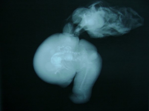 Pooperacyjne zdjcie Rtg usunitego FIF – wyranie wida krgosup i cz koci dugich; Gangopadhyay et al, CC BY 2.0; http://www.ncbi.nlm.nih.gov/pmc/articles/PMC2852393/