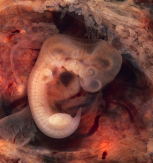 Zarodek, 10mm, w 7 tygodniu ciy (w tym akurat przypadku – pozamacicznej); Ed Uthman, MD, domena publiczna