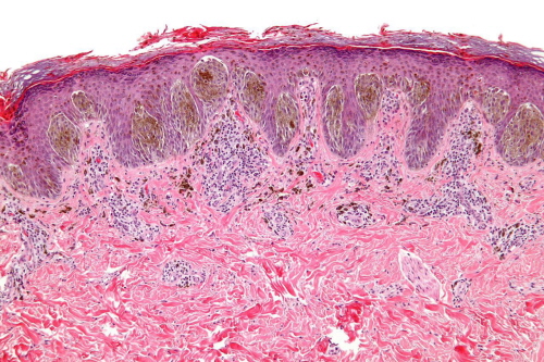 Znami Spitz z typowymi pionowo zorientowanymi owalnymi gniazdami lekko brzowo podbarwionych duych melanocytów na granicy naskórka i skóry waciwej; Nephron; CC BY-SA 3.0