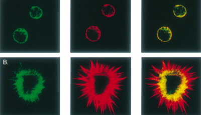 Na zielono wybarwiona aktyna, na czerwo – pp52, kolor óty pojawia si w miejscu ich nakadania si; na górze kontrolne limfocyty B, na dole – limfocyty biaaczki wochatokomórkowej; http://www.ncbi.nlm.nih.gov/pubmed/11137562/
