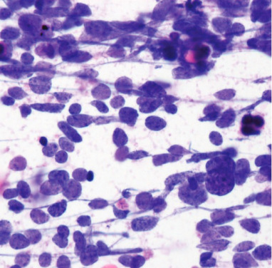 Jdra komórkowe o strukturze typu “sól i pieprz” w raku drobnokomórkowym puca; ©2010 College of American Pathologists z pozwoleniem na udostpnianie dla celów naukowych i edukacyjnych; http://www.archivesofpathology.org/doi/pdf/10.1043/2009-0583-RAR.1