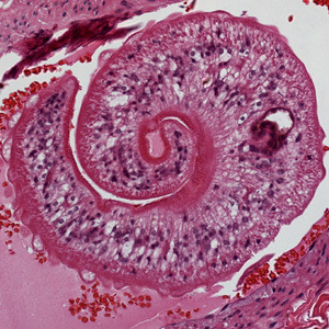 Dorosa przywra z rodzaju Schistosoma wewntrz naczynia krwiononego; http://www.cdc.gov/dpdx/schistosomiasis/gallery.html#xsection