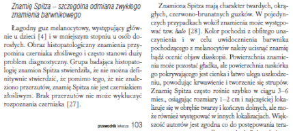 Fragment artykuu dotyczcego znamion barwnikowych; Przew Lek 2006; 7: 100-107; http://www.termedia.pl/Czasopismo/Przewodnik_Lekarza-8/Streszczenie-6886
