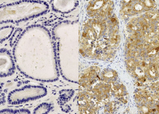 Wybarwione na brzowo biako CCR3; po lewej zdrowe gruczoy, po prawej – rak prostaty; http://www.nature.com/ncomms/2016/160112/ncomms10230/full/ncomms10230.html