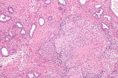 Ziarniniak po leczeniu BCG (duy, po prawej); Nephron, CC BY-SA 3.0, https://en.wikipedia.org/wiki/BCG_vaccine#/media/File:Granulomatous_inflammation_of_bladder_neck.jpg