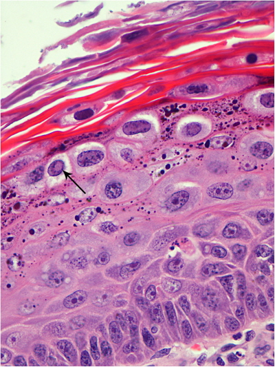 Koilocyty i ziarnistości wewnątrzkomórkowe w infekcji CPV, czyli psim HPV; CC-BY; http://www.ncbi.nlm.nih.gov/pmc/articles/PMC4234530/