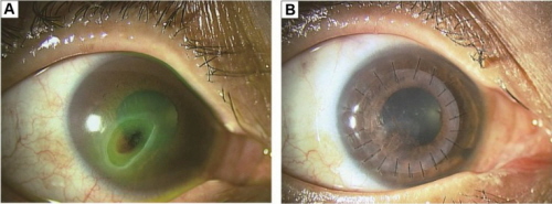 Rogówka przed i po keratoplastyce; po lewej gbokie owrzodzenie rogówki, po prawej pacjent po zabiegu, wokó rogówki widoczne szwy; CC BY-NC 3.0; http://www.ncbi.nlm.nih.gov/pmc/articles/PMC4218915/