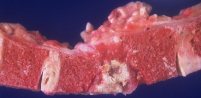 Gruźlica kręgosłupa; Yale Rosen, CC BY-SA 2.0, https://www.flickr.com/photos/pulmonary_pathology/6539943619/