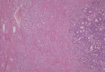 <span>Obraz mikroskopowy guza z poprzedniej ilustracji; idąc kolejno od lewej widać zdrowe pęcherzyki tarczycy, pasmo raka rdzeniastego pośrodku i po prawej cewki raka gruczołowego jelita grubego; </span>https://www.ncbi.nlm.nih.gov/pubmed/25368499