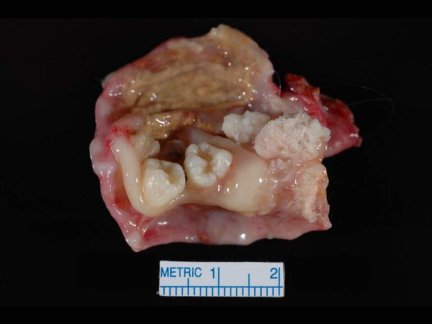 Ovarium dentatum nie bdzie naszym ostatnim sowem! fot. Sanjay Mukhopadhyay, https://twitter.com/smlungpathguy/status/724712614987706369