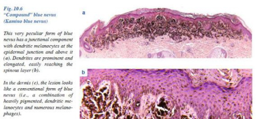 Znami Kamino; Guido Massi, Philip E. LeBoit – Histological Diagnosis of Nevi and Melanoma (2nd edition)