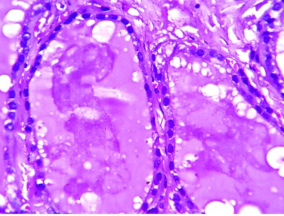 Zwyke wypenione koloidem pcherzyki tarczycowe, tyle e w jajniku; https://www.ncbi.nlm.nih.gov/pmc/articles/PMC4437124/