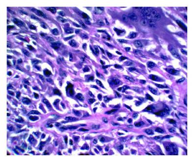 Mięsak podścieliskowy endometrium, nisko zróżnicowany nowotwór, z komórkami i jądrami komórkowymi różnych kształtów i rozmiarów; CC-BY, https://www.hindawi.com/journals/pri/2011/629840/