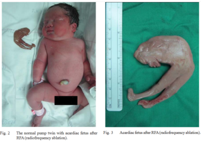 Odcięcie uszkodzonego płodu od krążenia zdrowego bliźniaka zazwyczaj pozwala uratować przynajmniej jedno z bliźniąt; http://www.jmatonline.com/index.php/jmat/article/view/6321