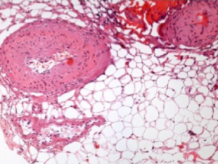 Grubocienne naczynia krwionone w obrbie dojrzaej tkanki tuszczowej – tuszczak ciaa modzelowatego; CC-BY, https://www.ncbi.nlm.nih.gov/pmc/articles/PMC4442262/