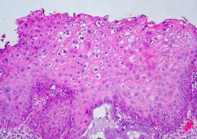 Koilocyty w nabłonku płaskim tarczy części pochwowej szyjki macicy, w którym rozpoczęło się już nowotworzenie; Ed Uthman; CC BY-SA 2.0