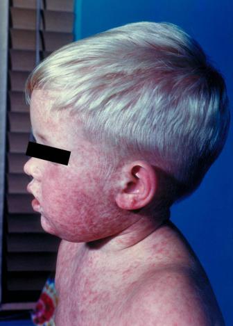 Odra – wysypka u dziecka; CDC, Public Health Image Library (PHIL)