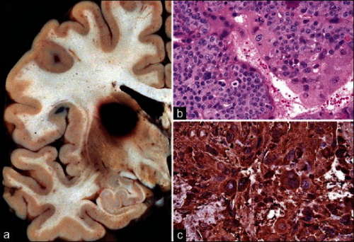 Przerzut raka kosmówki w mózgu; po prawej na górze obraz mikroskopowy wybarwiony standardowo, z dou dodatkowe barwienie immunohistochemiczne; CC-BY; http://www.ncbi.nlm.nih.gov/pmc/articles/PMC3656562/