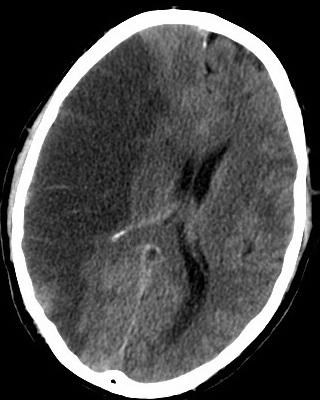 Obraz TK prawostronnego udaru niedokrwiennego mózgu (ciemniejsza plama po lewej stronie zdjęcia); Lucien Monfils; Wikipedia; CC BY-SA 3.0