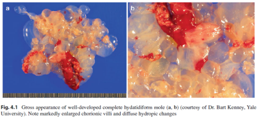 Biedny wty czowiek, czyli podrcznikowy przykad zaniadu groniastego. Gestational Trophoblastic Disease. Diagnostic and Molecular Genetic Pathology. Humana Press, 2012; ed. Pei Hui