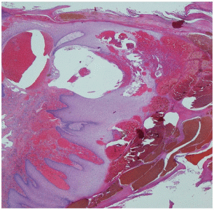 <span>Obraz mikroskopowy rogowca krwawego peen rozdtych bbli wypenionych krwi wrzynajcych si na oko w gb naskórka; </span>http://adc.bmj.com/content/100/7/630