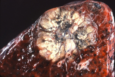 <span>Obwodowo zlokalizowany rak gruczołowy płuca; Yale Rosen, CC BY-SA 2.0, </span>https://www.flickr.com/photos/pulmonary_pathology/3922611807
