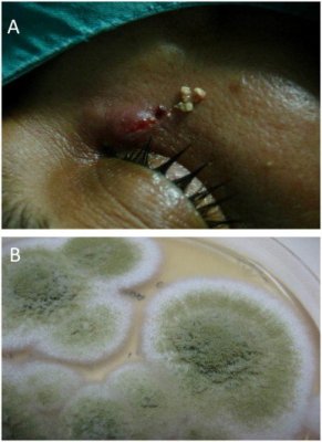 Drobne dakriolity u ujcia ropnej przetoki – w tym przypadku z materiau z przetoki wyhodowano grzyby (Aspergillus fumigatus); https://www.ncbi.nlm.nih.gov/pmc/articles/PMC3854766/, CC BY-NC-ND 3.0