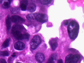 Komórki raka urotelialnego pcherza moczowego z bardzo bliska; CC BY 2.0, https://www.ncbi.nlm.nih.gov/pmc/articles/PMC1310524/