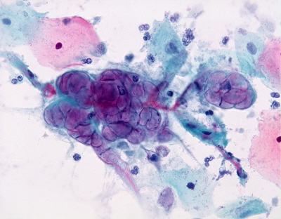 Infekcja HSV, cytologia ginekologiczna, http://www.pathologyoutlines.com/topic/cervixcytologyHSV.html