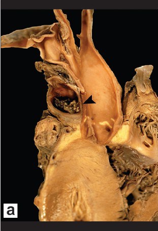 Rozcity pie pucny (obok, po prawej – aorta, na dole przekrój przez misie sercowy), strzaka wskazuje skrzeplin w jego wietle; CC BY-NC-SA 3.0; http://www.ncbi.nlm.nih.gov/pubmed/19332925