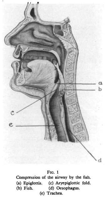 Rybka, która zaklinowaa si na poziomie krtani, rys anatomiczny (kolejno – nagonia, ryba, fad nalewkowo-nagoniowy, przeyk, tchawica); https://www.ncbi.nlm.nih.gov/pubmed/5949967