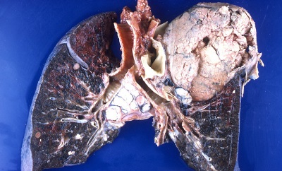 <span>Ten rak puc zaj cay górny pat lewego puca, dajc przerzuty zarówno do puca prawego, jak i (porodku, pod rozwidleniem tchawicy) do wzów chonnych; Yale Rosen, CC BY-SA 2.0, </span>https://www.flickr.com/photos/pulmonary_pathology/3922612069/