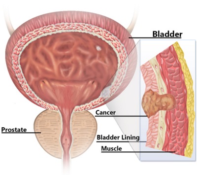 Pcherz moczowy i jego ciana nacieczona przez docierajcy do warstwy miniowej nowotwór zoliwy na przekroju [bladder – pcherz, cancer – nowotwór zoliwy, lining – wycióka, muscle – misie]; U.S. National Library of Medicine; https://ghr.nlm.nih.gov/condition/bladder-cancer