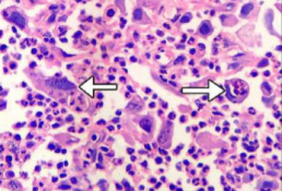 Strzaki pokazuj poarte przez komórki raka jamy ustnej leukocyty; http://www.ncbi.nlm.nih.gov/pubmed/24450575