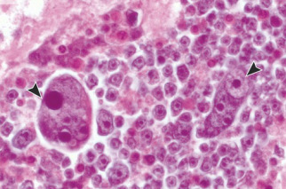 Komórki nowotworowe z bliska – strzaki pokazuj te powikszone , wielojdrzaste, z olbrzymimi jderkami (jednolite fioletowe kropy); http://www.nejm.org/doi/ref/10.1056/NEJMoa1505892#t=article