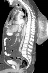 <span>Pilomatrixoma to zwykle drobny guz, ale nie zawsze; </span>https://www.ncbi.nlm.nih.gov/pmc/articles/PMC4339831/